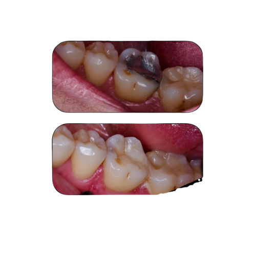 الحشوات التجميلية